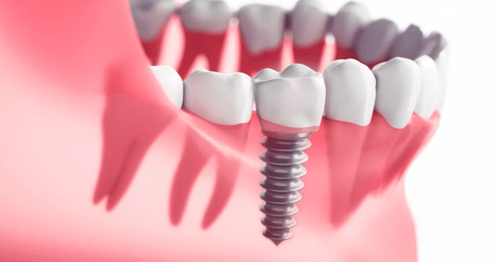 Dental Implants at home in Hyderabad – Prudentoe