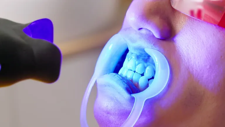 Teeth Whitening at home in Hyderabad – Prudentoe