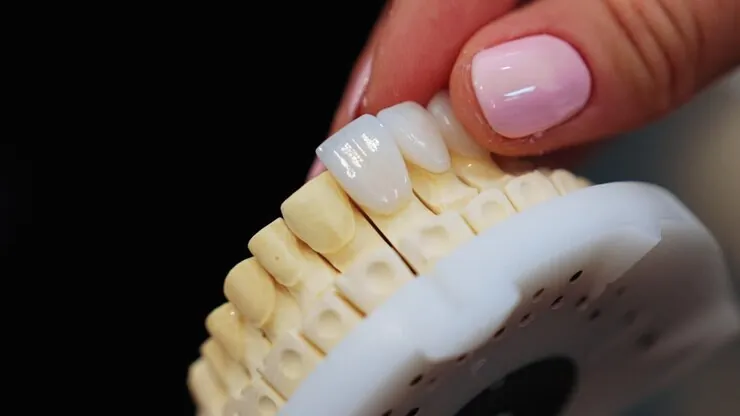 Dental Veneers at home in Hyderabad – Prudentoe