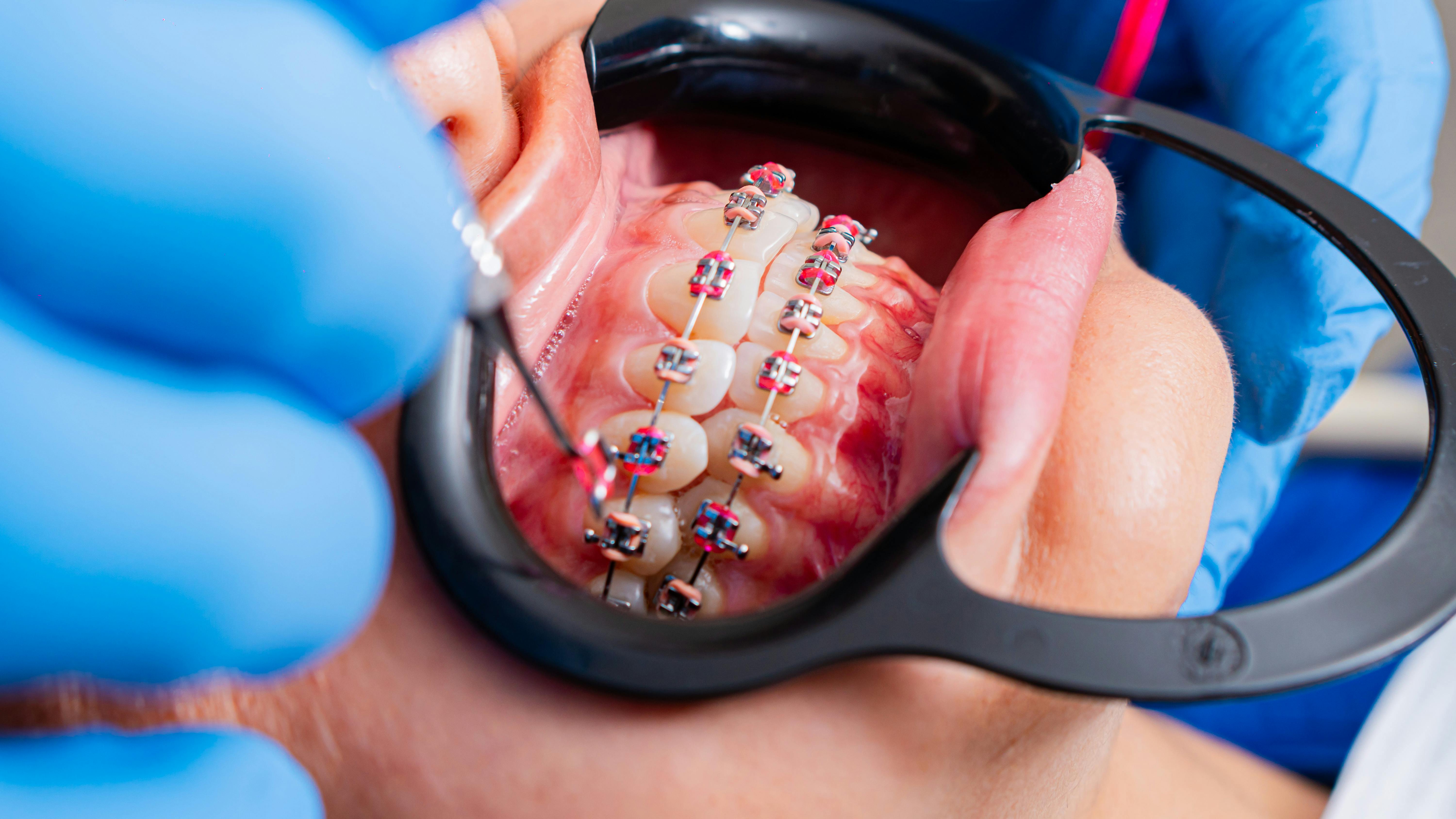 Prudentoe orthodontist fitting metal or ceramic dental braces for teeth alignment at a patient's home in Hyderabad