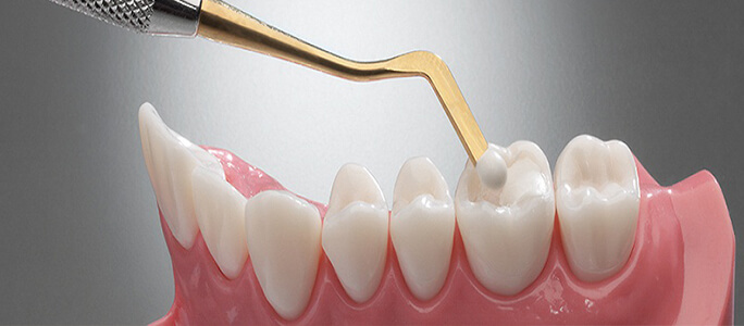 Prudentoe dentist placing a shade-matched tooth-coloured composite filling at a patient's home in Hyderabad