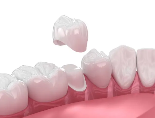 Prudentoe dentist fitting a custom dental crown restoration on a patient's tooth at home in Hyderabad