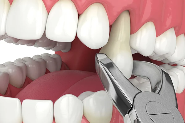Prudentoe dental surgeon performing a painless tooth extraction procedure at a patient's home in Hyderabad