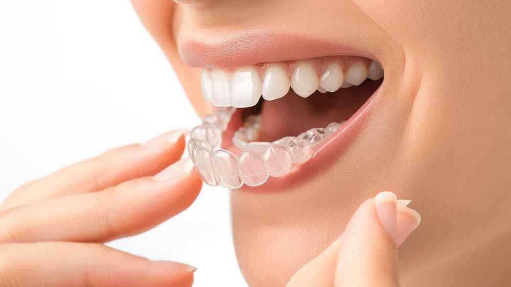 You are currently viewing Benefits of clear Aligners over Traditional Braces –