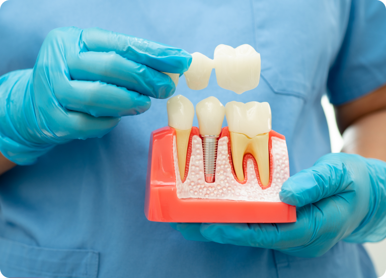 dental-implants-hyderabad