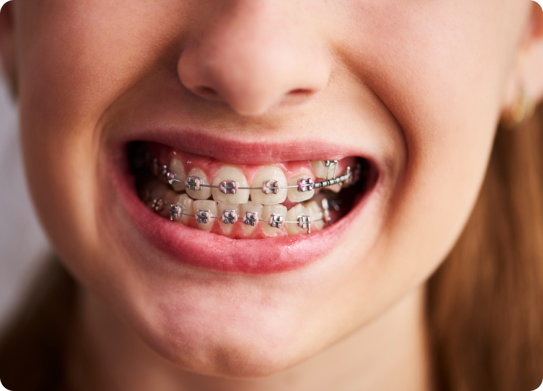 teeth-cleaning-price-in-hyderabad